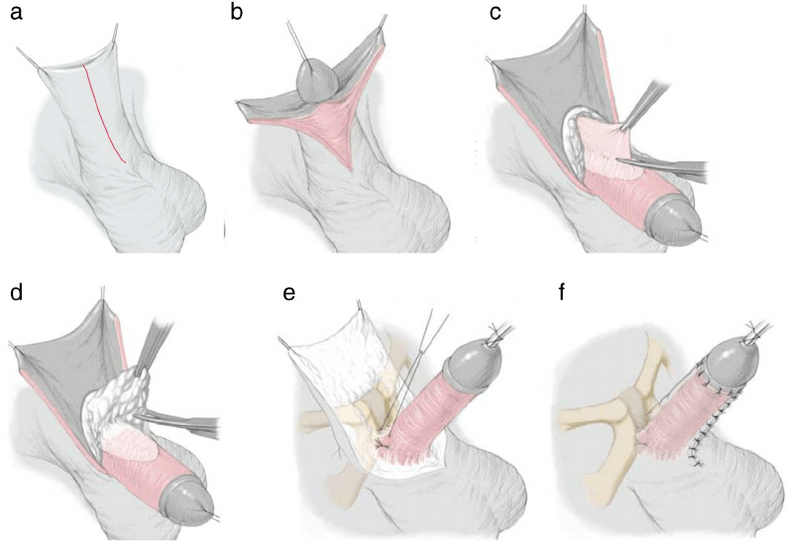 ligamentotomy үчүн жыныстык мүчөсүн көбөйтүү